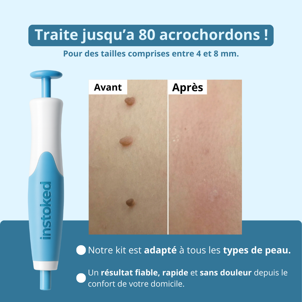Éliminateur d’excroissances de peau (Anti-acrochordons)