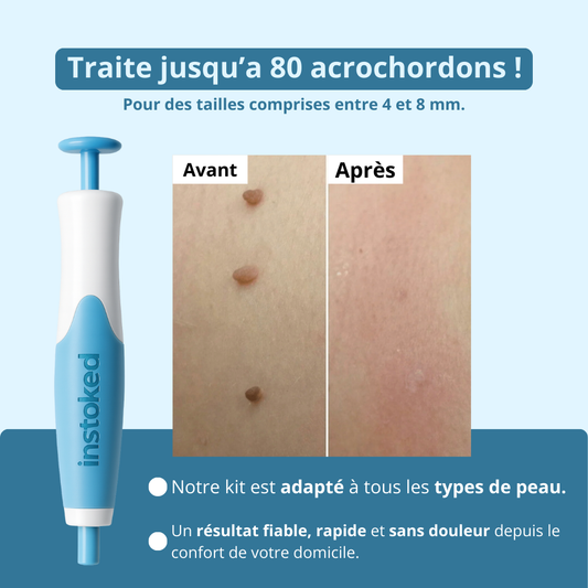 Éliminateur d’excroissances de peau (Anti-acrochordons)
