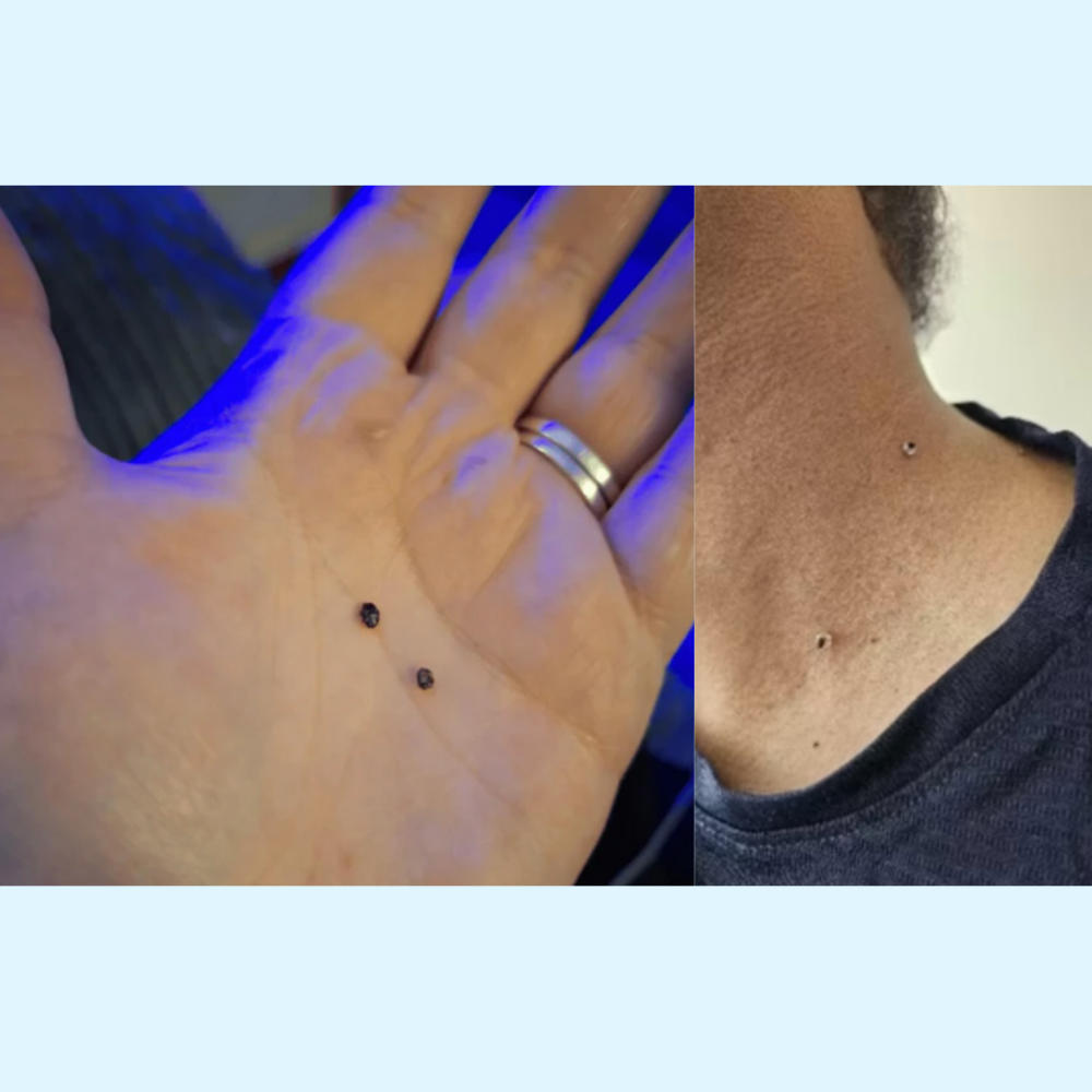 Éliminateur d’excroissances de peau (Anti-acrochordons)