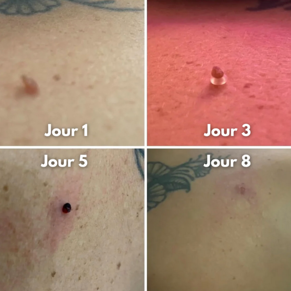 Éliminateur d’excroissances de peau (Anti-acrochordons)