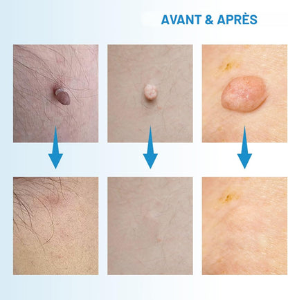 Éliminateur d’excroissances de peau (Anti-acrochordons)