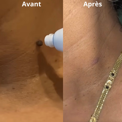 Éliminateur d’excroissances de peau (Anti-acrochordons)